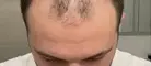 Hair thinning
