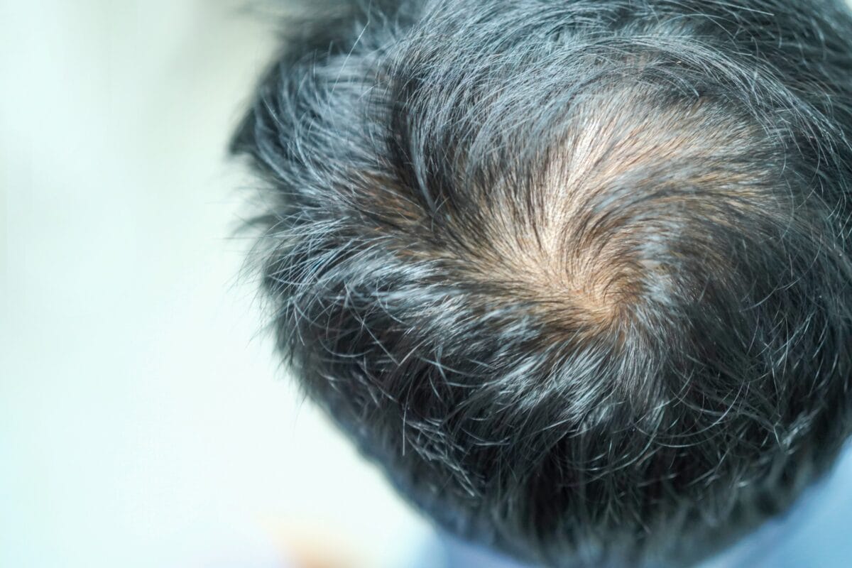 Propecia Side Effects: An Honest, Evidence-Based Guide