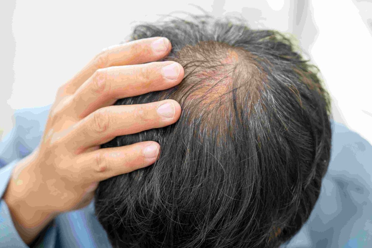 How to Stop Hair Loss in Men: Proven Treatments and Strategies
