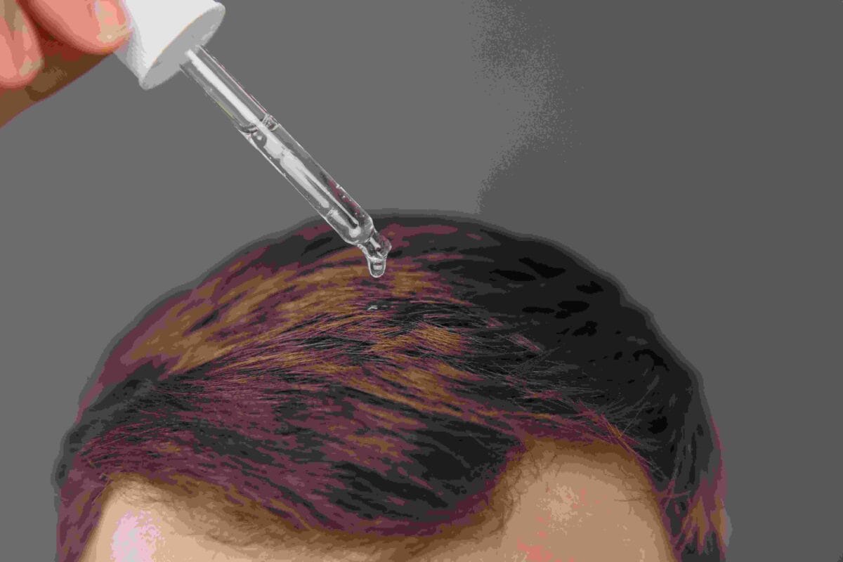 Topical Dutasteride for Hair Loss: How It Works and UK Access