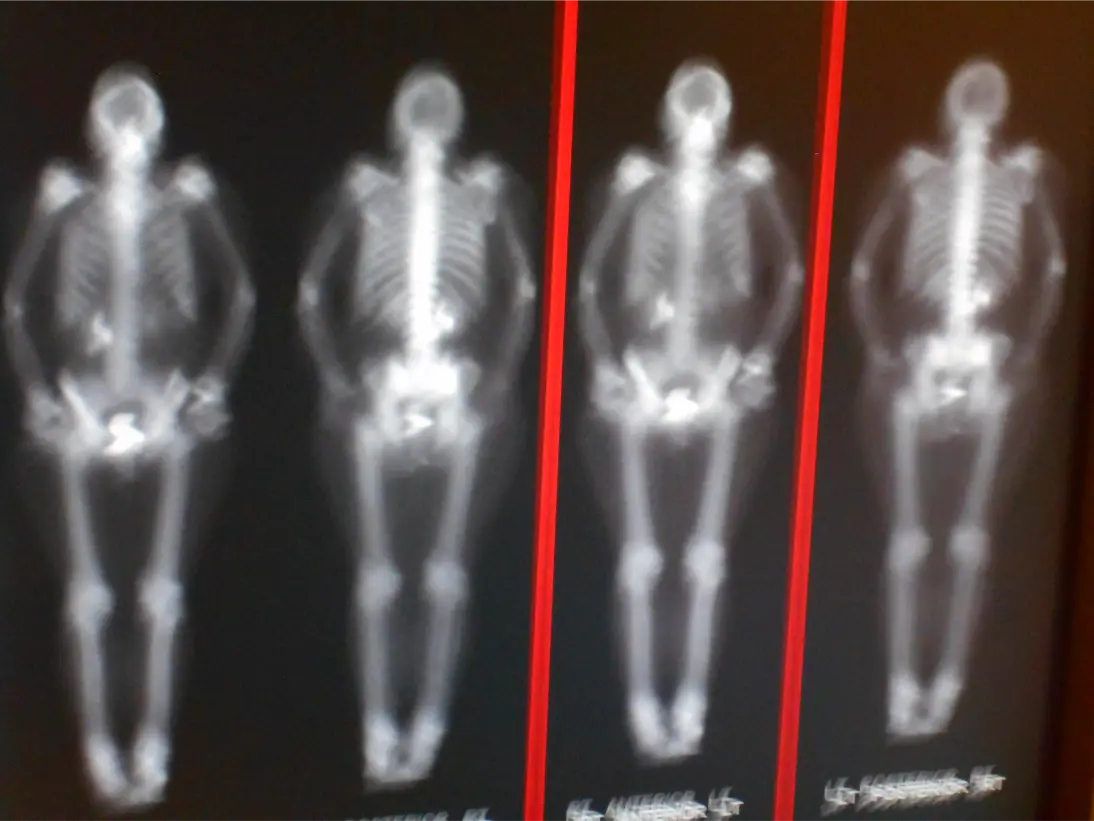 Testosterone and Bone Density: Why Fracture Risk Matters More Than You Think